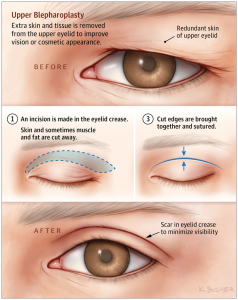 Blepharoplastik (Augenlidoperation)