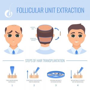 FUE Haartransplantation