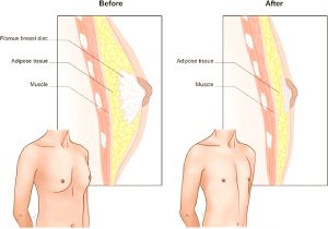 Gynäkomastie Chirurgie