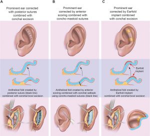 Prominent Ear Correction