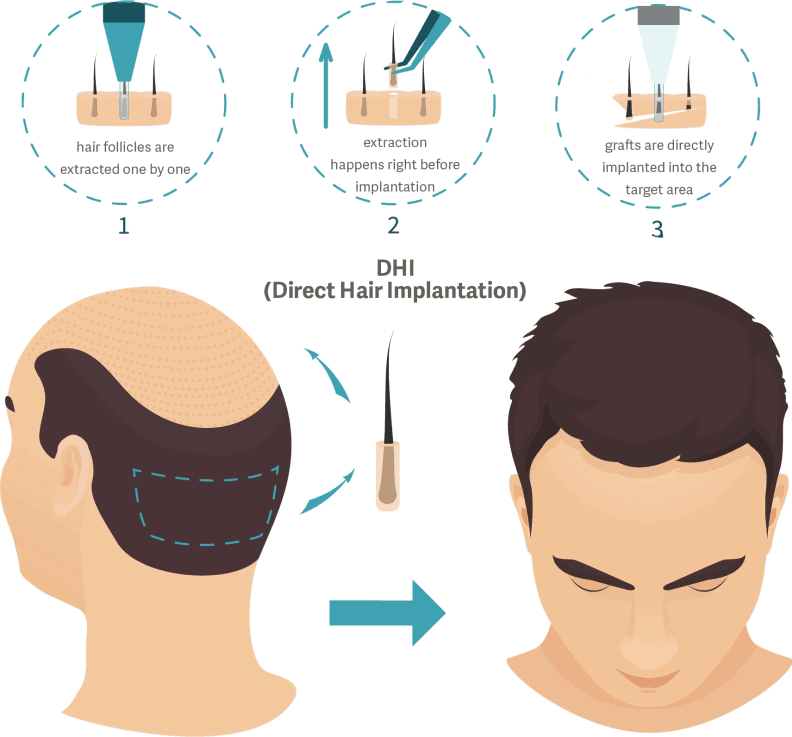 dhi hair transplant