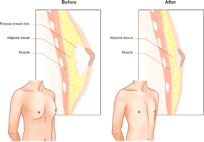 Gynecomastia Surgery Procedure