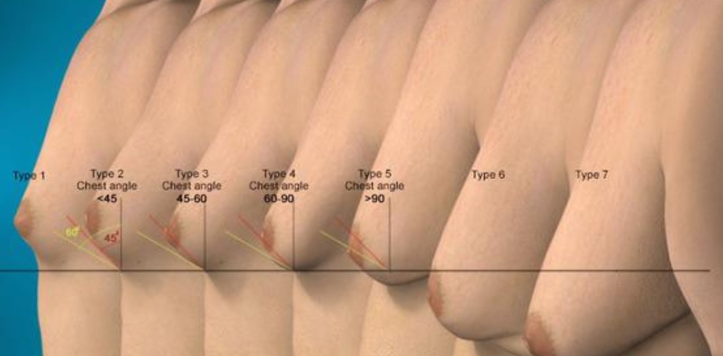 Gynecomastia Stages