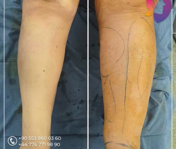 lipedema surgery turkey