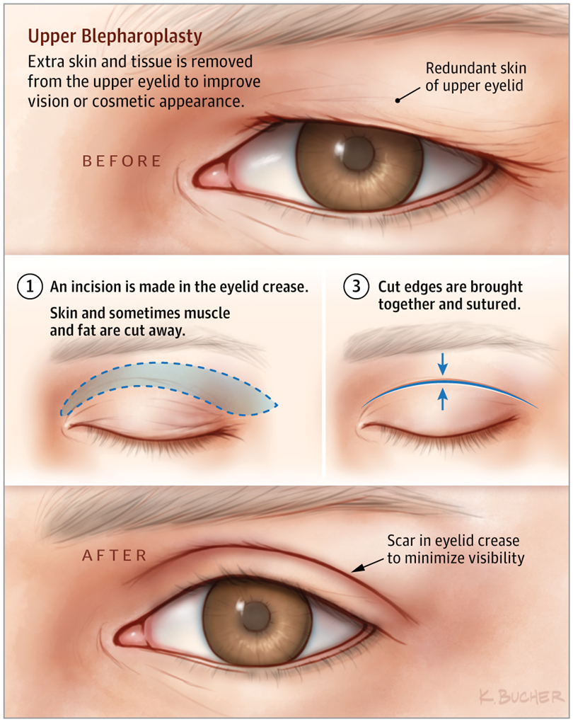 Eyelid Surgery Cost in Istanbul Turkey Dr.Resat AKTAS